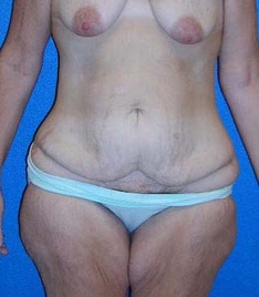 Tummy Tuck