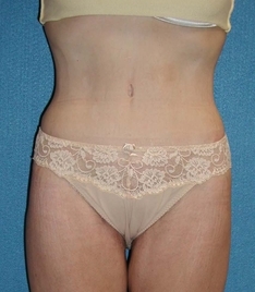 Tummy Tuck