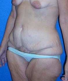 Tummy Tuck