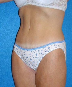 Tummy Tuck