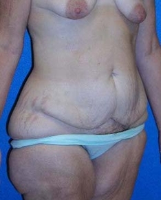 Tummy Tuck