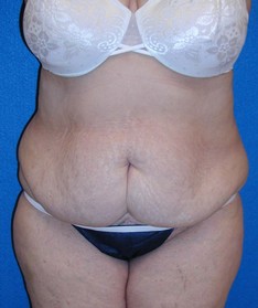 Tummy Tuck