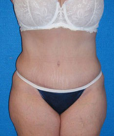 Tummy Tuck