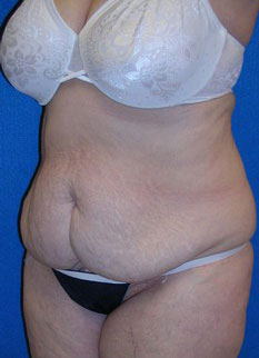 Tummy Tuck