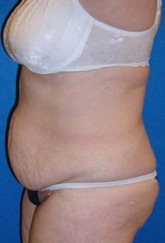 Tummy Tuck