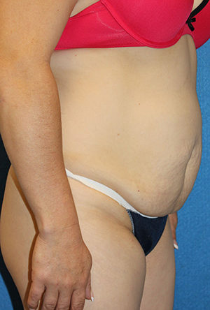 Tummy Tuck