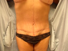 Tummy Tuck