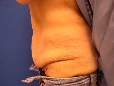 Tummy Tuck