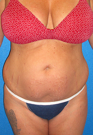 Tummy Tuck