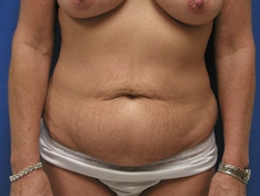 Tummy Tuck