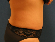 Tummy Tuck