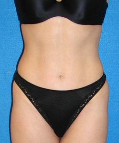 Tummy Tuck