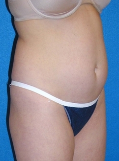 Tummy Tuck