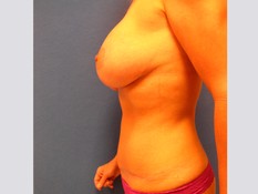 Tummy Tuck