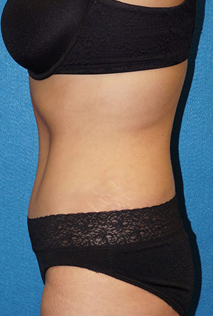 Tummy Tuck