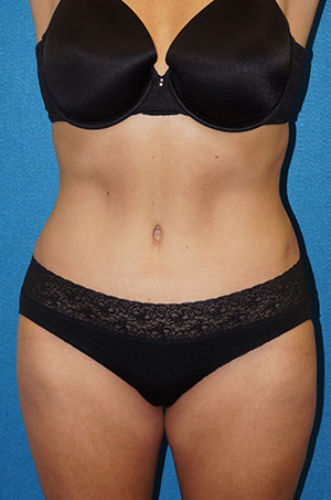 Tummy Tuck