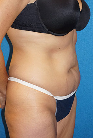 Tummy Tuck