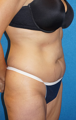 Tummy Tuck