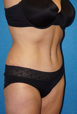 Tummy Tuck