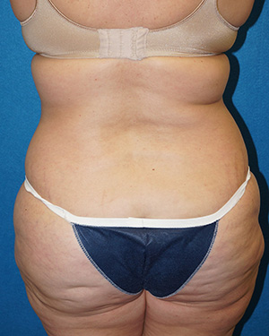 Tummy Tuck