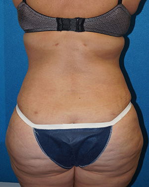 Tummy Tuck