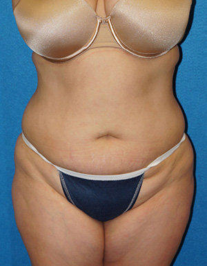 Tummy Tuck