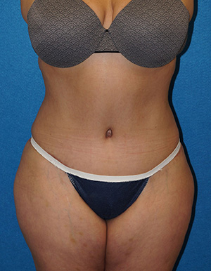 Tummy Tuck