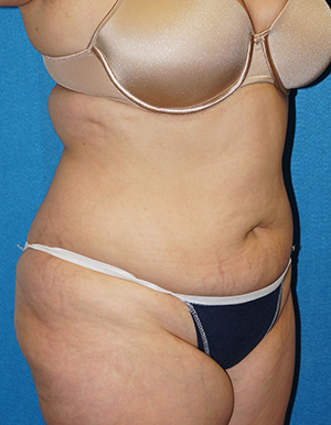 Tummy Tuck