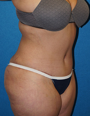 Tummy Tuck