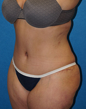 Tummy Tuck