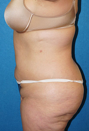 Tummy Tuck