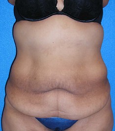 Tummy Tuck