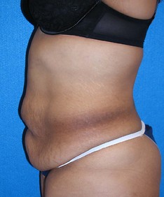 Tummy Tuck