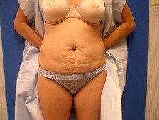 Tummy Tuck