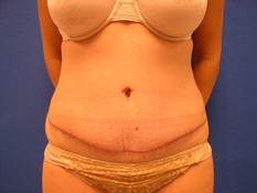 Tummy Tuck