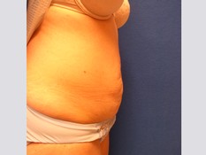 Tummy Tuck