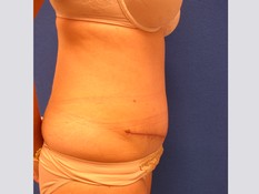 Tummy Tuck