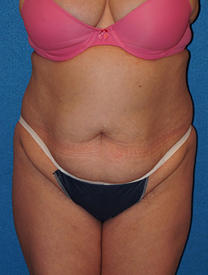 Tummy Tuck