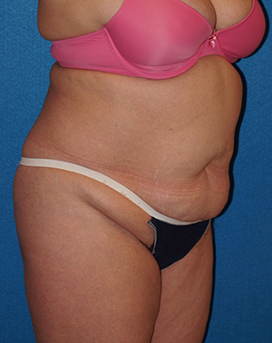 Tummy Tuck