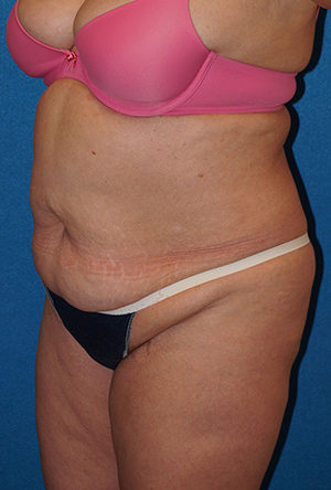 Tummy Tuck