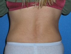 Tummy Tuck