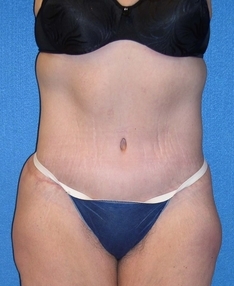 Tummy Tuck