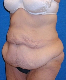 Tummy Tuck