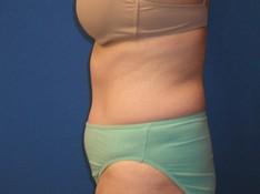 Tummy Tuck