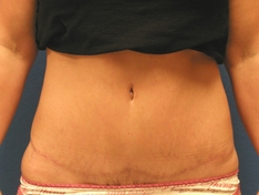 Tummy Tuck