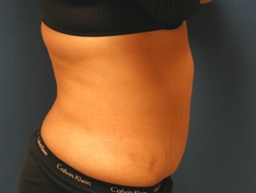 Tummy Tuck