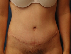 Tummy Tuck