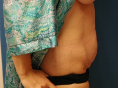 Tummy Tuck