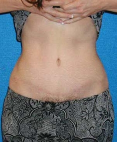 Tummy Tuck