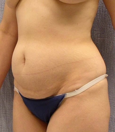 Tummy Tuck